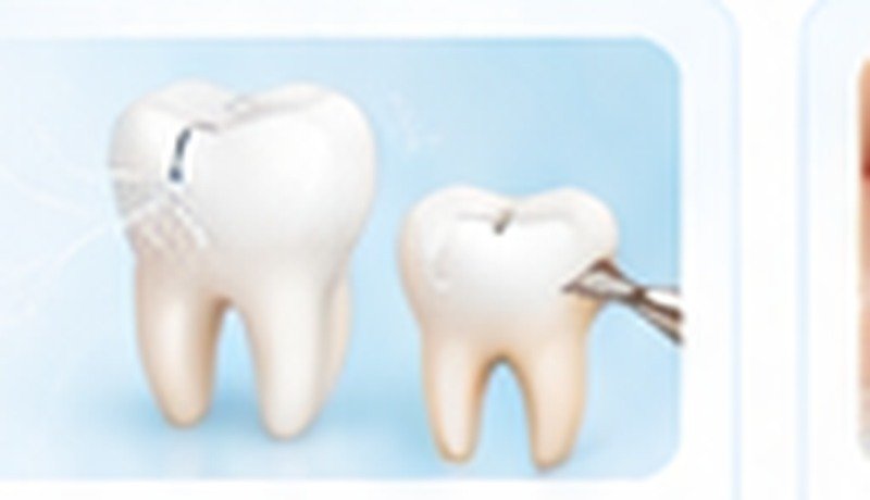 Veneers & Crowns