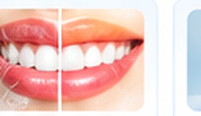 Teeth Whitening