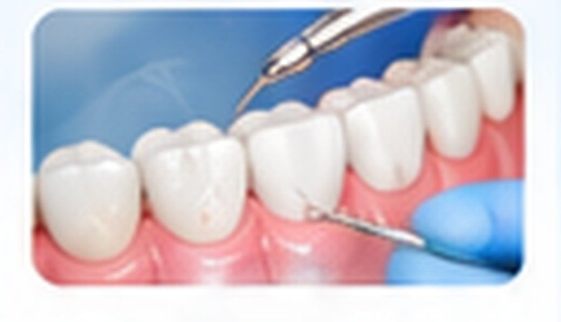Teeth Cleaning
