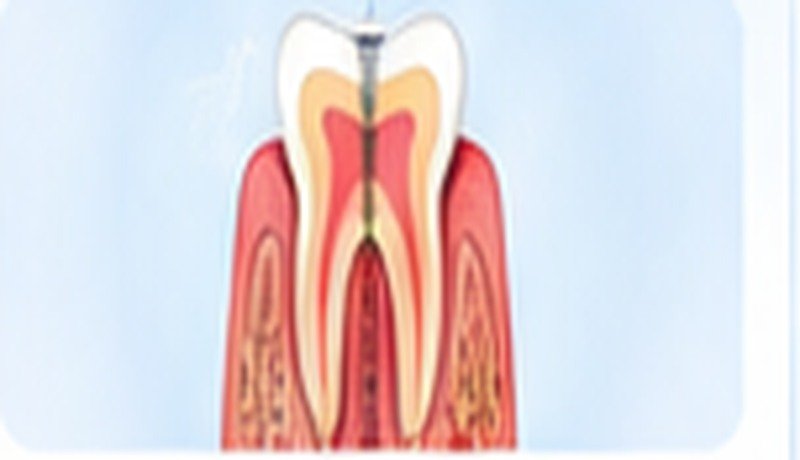 Root Canals