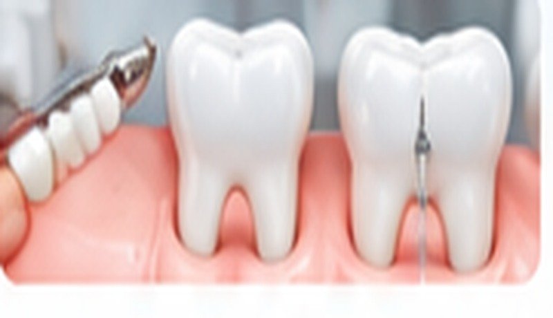 Root Canal, Fillings, Crown & Bridge, Cleaning Up